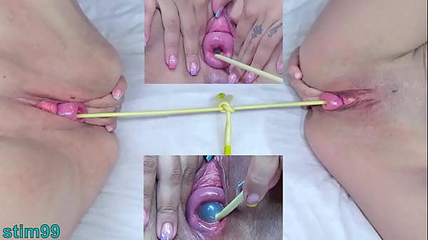 Prolapsed Cervix Lesbians at the same time